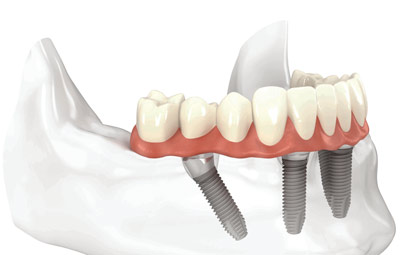 Implant Retained Dentures